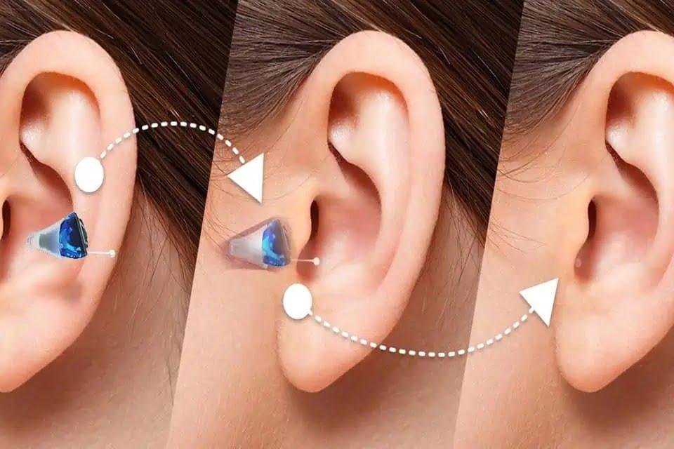 Widex Hearing Aid